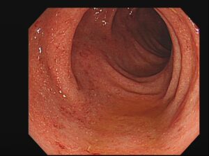 潰瘍性大腸炎
