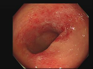 虚血性大腸炎