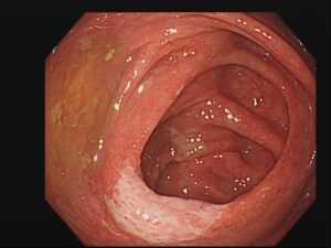 感染性腸炎